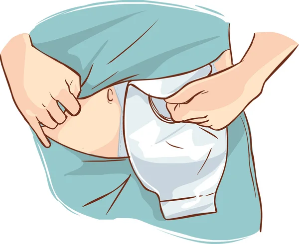 Ostomía bolsa ilustración — Vector de stock