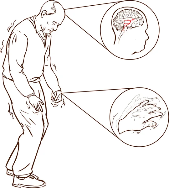 Vieil homme avec des symptômes de Parkinson marche difficile — Image vectorielle