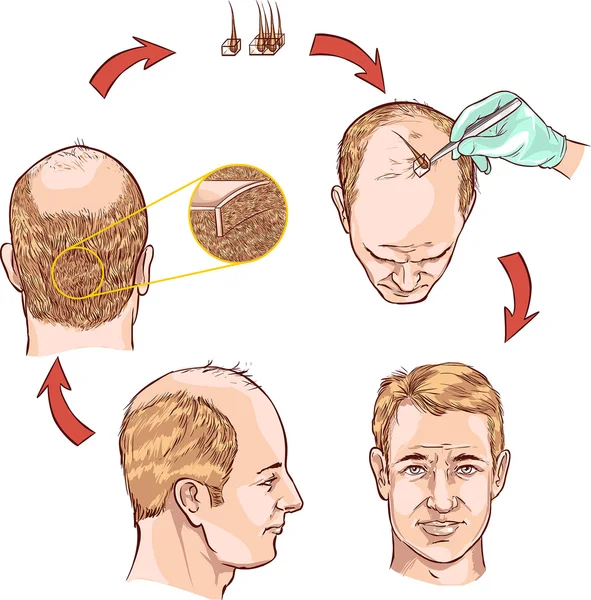 Ilustración vectorial de un trasplante de cabello — Archivo Imágenes Vectoriales