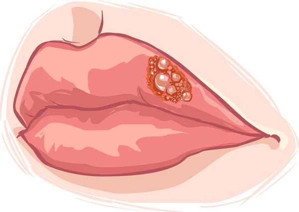 Vektor illustration av en läpp herpes — Stock vektor