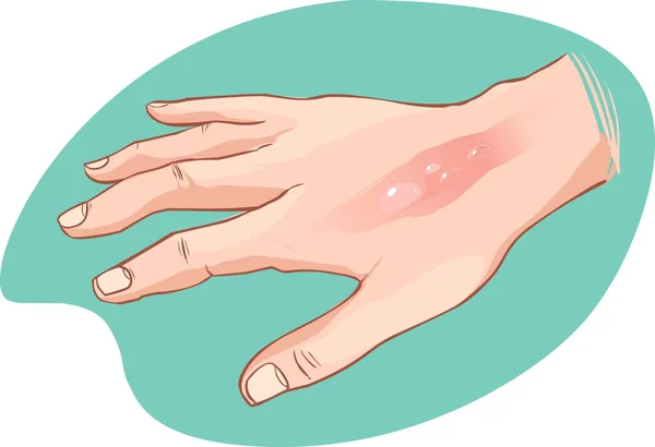 Vector illustration of a hand burn — Stock Vector