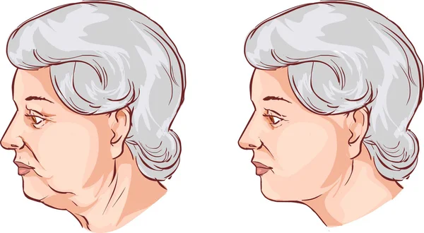 Ilustración vectorial de un lifting facial antes y después del tratamiento — Vector de stock