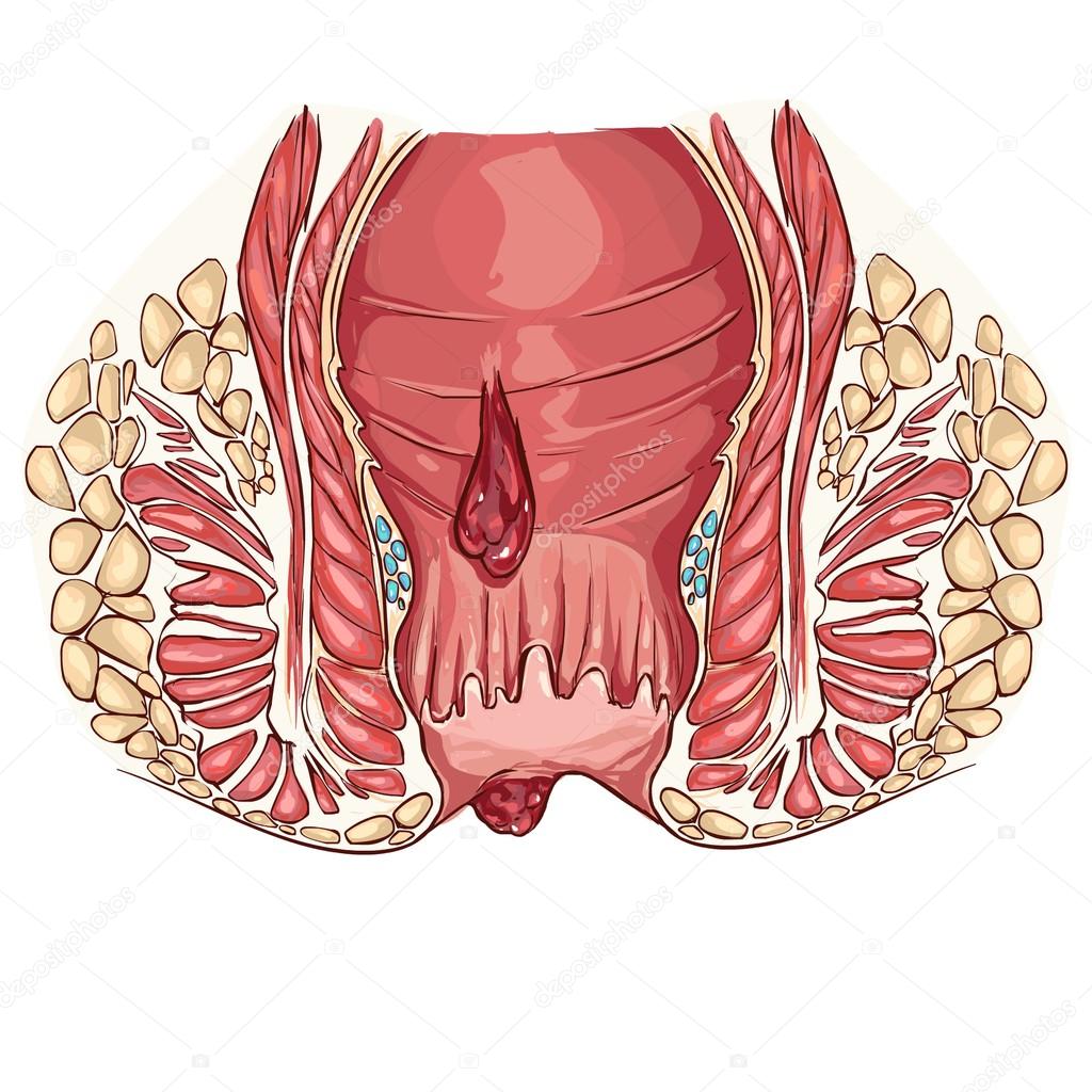 vector illustration of a hemorrhoids