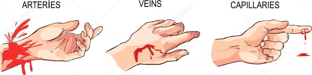 Arterial and venous bleeding