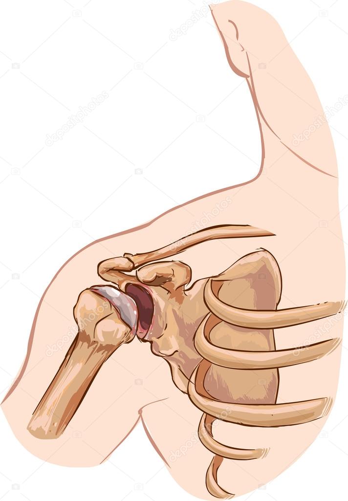 Vector illustration of a shoulder dislocation Stock Vector Image by  © #95122904
