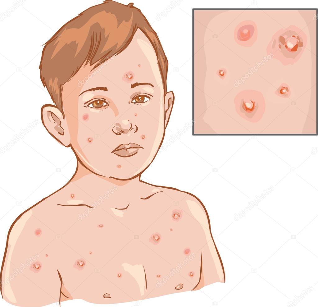 Chicken pox Vector Art Stock Images | Depositphotos Chicken pox Vector Art Stock Images | Depositphotos