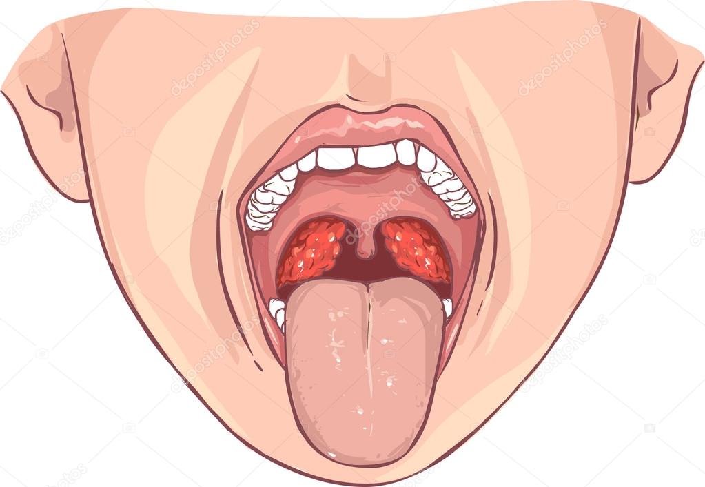 vector illustration of a Tonsillitis bacterial