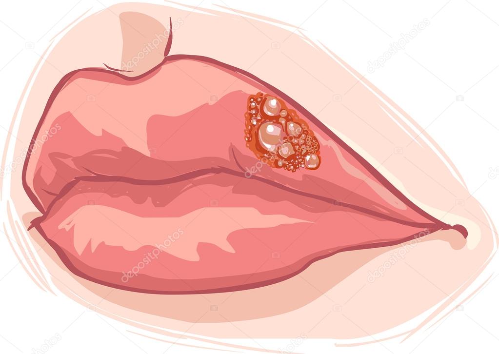 vector illustration of a lip herpes