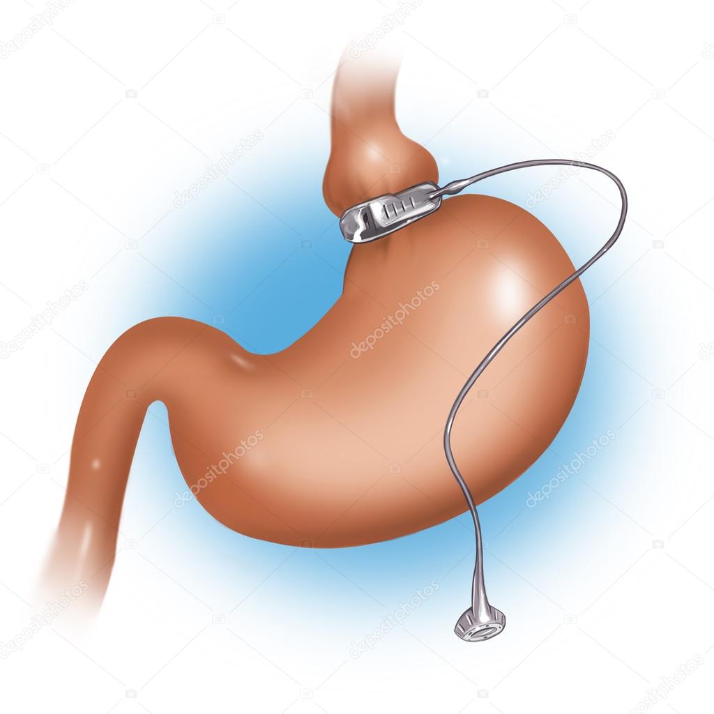 Gastric Band Weight Loss Surgery illustration