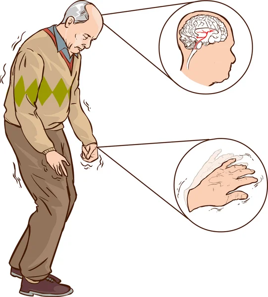 Vieil homme avec des symptômes de Parkinson marche difficile — Image vectorielle