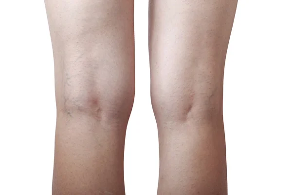 El flebeurismo en las piernas — Foto de Stock