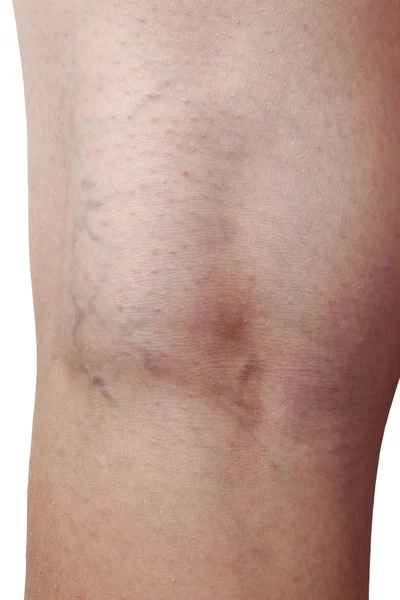 Der Schleimhautentzündung an den Beinen — Stockfoto