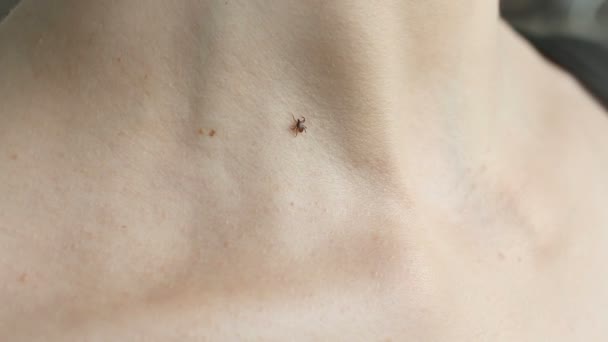 Tick crawling on human Skin — Stock Video