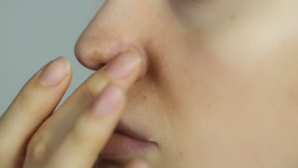 Herpes On The Nose Young Woman With Herpes On Her Nose Stock