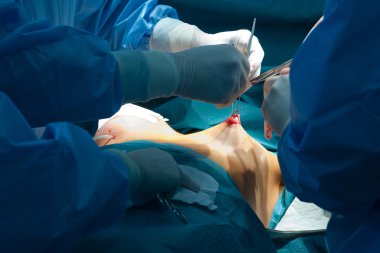 Göğüs büyütme, plastik cerrahi