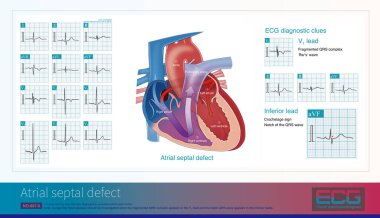 Parçalanmış QRS kompleksi ECG 'nin V1 liderliğinde alt mermide QRS dalgasının çentiğiyle göründüğünde, ki bu kanca işaretidir, konjenital kalp hastalıklarını taramak gereklidir..