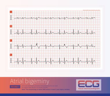 Sinüs ritmi ve atriyal ritim değişimi. Prematüre atriyal kasılmaların QRS kompleksine çeşitli iventriküler anormal iletkenlik dereceleri eşlik etmektedir..