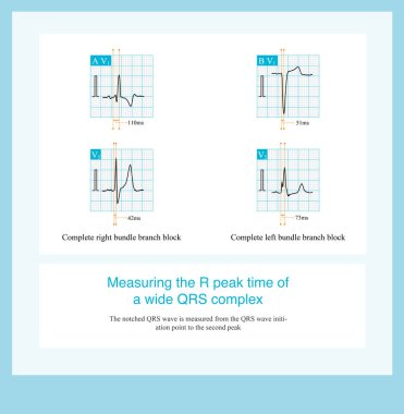 Geniş bir QRS dalgası bağlamında, R tepe süresi genellikle QRS dalga başlatma noktasından ikinci çentiğin zirvesine kadar ölçülür.