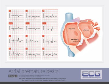 Prematüre atriyal kasılmalar koroner sinüs ostiyumundan kaynaklandığında P dalgası alt uçlarda ters döner ve kurşun aVR ve aVL 'de dik durur..