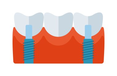 diş implantı vektör çizimi