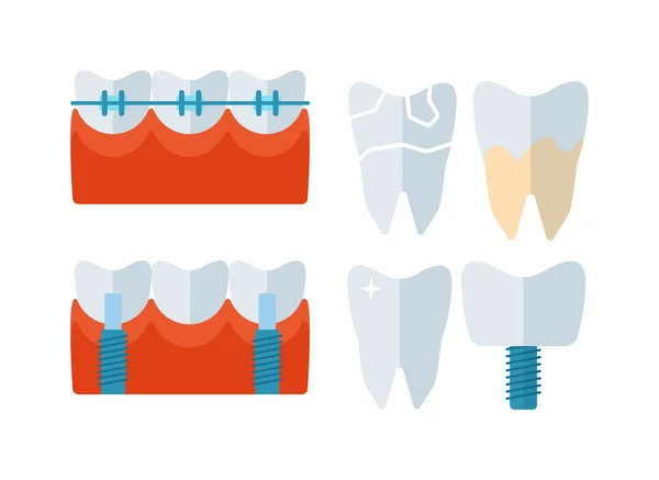 Tooth implant vector illustration — Stock Vector