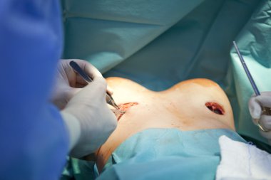 meme büyütme operasyonu ameliyathane cerrah araçları implant