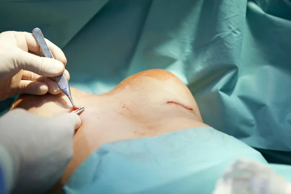 Bröstförstoring kirurgi i operationssalen kirurg verktyg implantat — Stockfoto