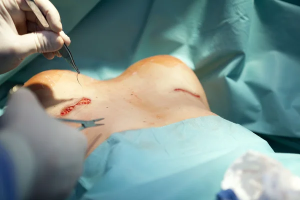 在手术室外科医生工具隆胸手术植入 — 图库照片