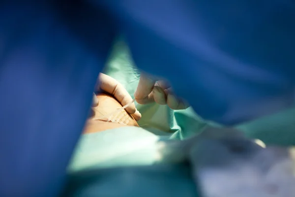 E mellnagyobbító műtét a műtőben sebész eszközök implantátum — Stock Fotó
