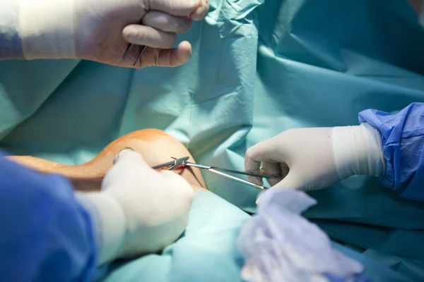 Εμφυτεύματος χειρουργική επέμβαση αύξησης στηθών στο χειρουργείο χειρουργός εργαλεία Royalty Free Εικόνες Αρχείου
