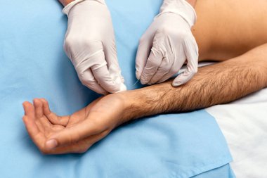 Erkek müşteriye akupunktur yapan tanınmamış işçilerin resmi.