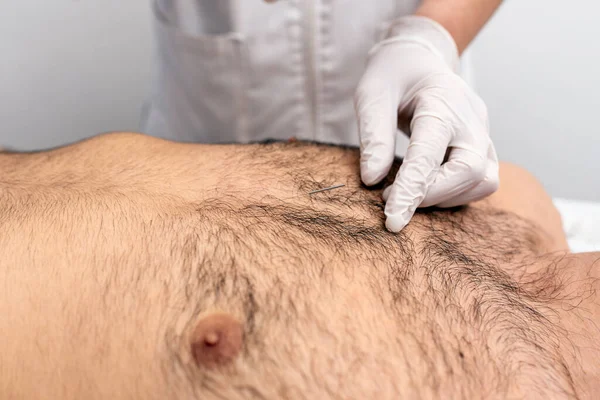 Foto Stock Trabajador Reconocido Haciendo Procedimiento Acupuntura Cliente Masculino —  Fotos de Stock