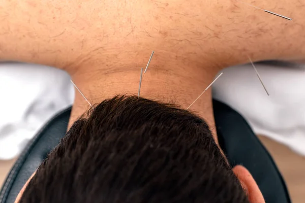 Stock Photo Unrecognized Worker Doing Acupuncture Procedure Male Client — Stock fotografie
