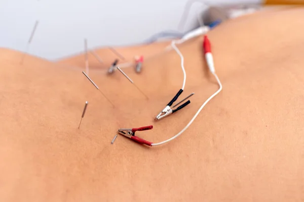 Kimliği Belirsiz Birinin Sırt Ağrısı Için Akupunktur Tedavisi Görürken Çekilmiş — Stok fotoğraf