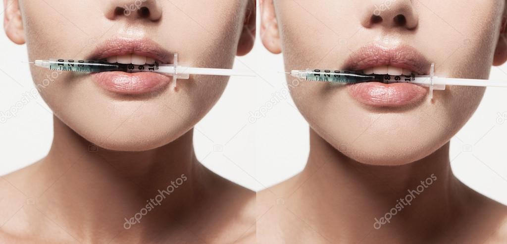 Female lips before and after augmentation