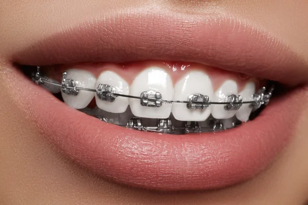 Vacker makro skott av vita tänder med hängslen. Tandvårdsfoto. Skönhet kvinna leende med ortodontiska tillbehör. Ortodonti behandling. Närbild av friska kvinnliga munnen — Stockfoto