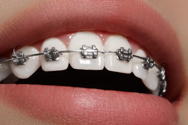 Hermoso macroplano de dientes blancos con aparatos ortopédicos. Foto de cuidado dental. Mujer belleza sonrisa con accesorios de ortodoncia. Tratamiento de ortodoncia. Primer plano de la boca femenina saludable —  Fotos de Stock