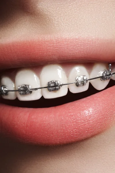 Hermoso macroplano de dientes blancos con aparatos ortopédicos. Foto de cuidado dental. Mujer belleza sonrisa con accesorios de ortodoncia. Tratamiento de ortodoncia. Primer plano de la boca femenina saludable — Foto de Stock