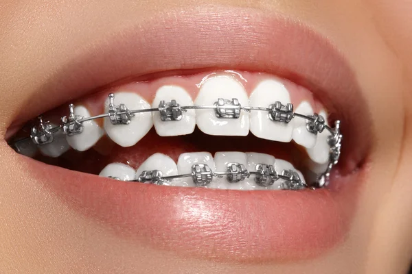 Beautiful macro shot of white teeth with braces. Dental care photo. Beauty woman smile with ortodontic accessories. Orthodontics treatment. Closeup of healthy female mouth