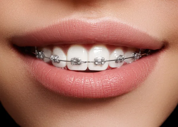 Hermoso macroplano de dientes blancos con aparatos ortopédicos. Foto de cuidado dental. Mujer belleza sonrisa con accesorios de ortodoncia. Tratamiento de ortodoncia. Primer plano de la boca femenina saludable —  Fotos de Stock