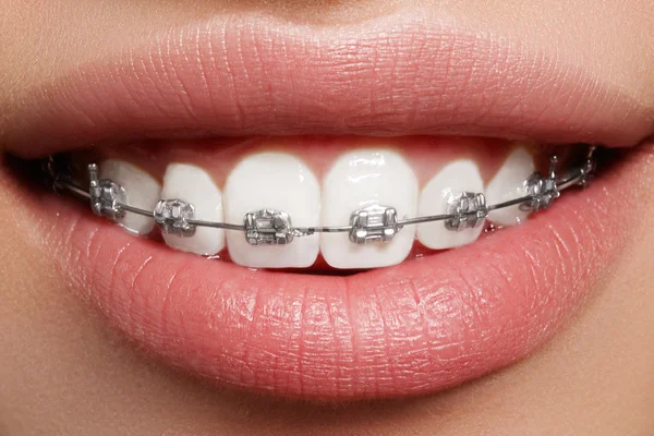 Bellissimo macro shot di denti bianchi con bretelle. Foto di cura dentale. Bellezza donna sorriso con accessori ortodontici. Trattamento ortodontico. Primo piano della bocca femminile sana — Foto Stock