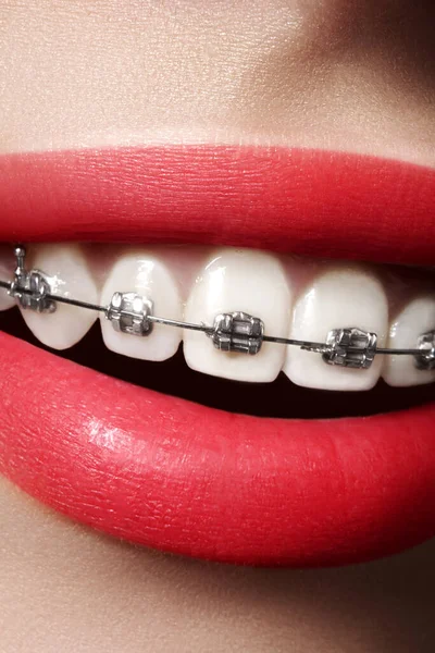 Beautiful Macro Shot White Teeth Braces Beauty Woman Smile Red — Stock Photo, Image