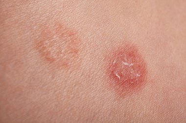 Yakın plan iltihaplı cilt lezyonları Kabuk, Kızarıklık, Hasta Gövdesi Renk Bozukluğu, Nemli Kabuk ve Sert Doku, Klinik Dermatoloji, Epidermal Detay, Derma