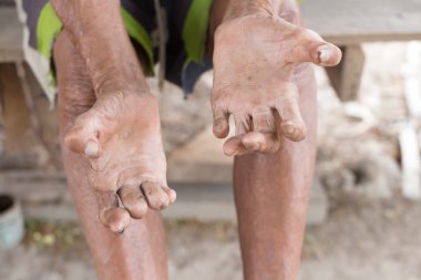 Hansen hastalığı, cüzzamdan muzdarip yaşlı adamın elleri, kesilmiş eller.
