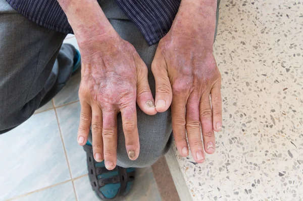 Arka elinde deri bozukluğu var.