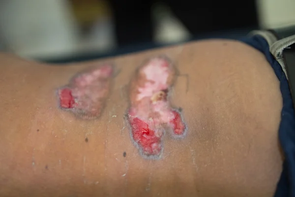 Deri bozukluğu, deri iltihabı yarası.