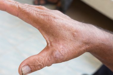 Elinde deri bozukluğu var.