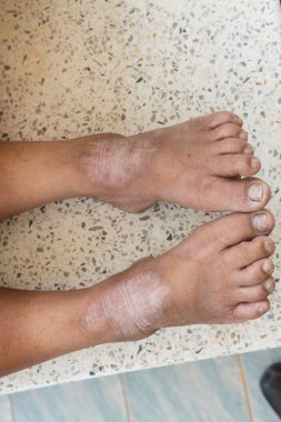 Yaya olarak deri bozukluğu.