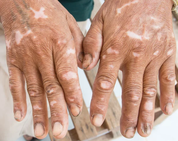 Розлад Шкіри Під Рукою — стокове фото
