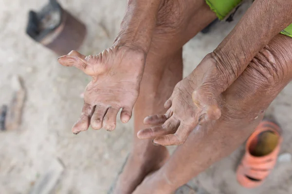 Hansen hastalığı, cüzzamdan muzdarip yaşlı adamın elleri, kesilmiş eller.